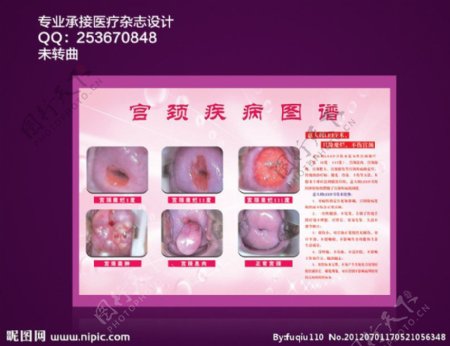 宫颈疾病图谱图片