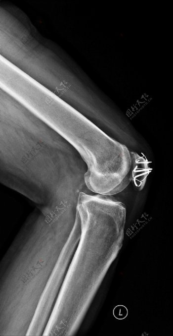 X线照片膝关节图片
