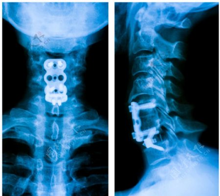 颈椎X光片图片