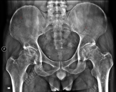 X线拍片骨盆图片