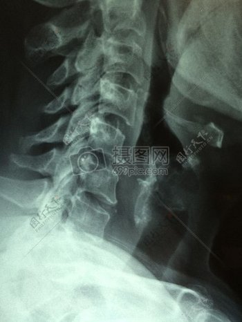 脊椎的CT透图