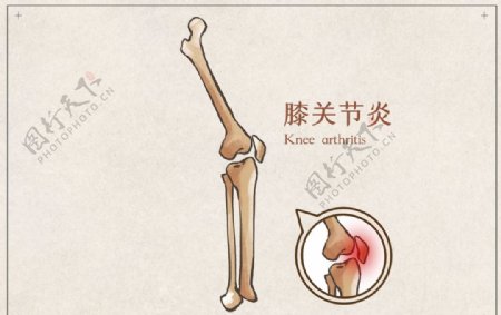 膝关节炎骨骼宣传展板素材